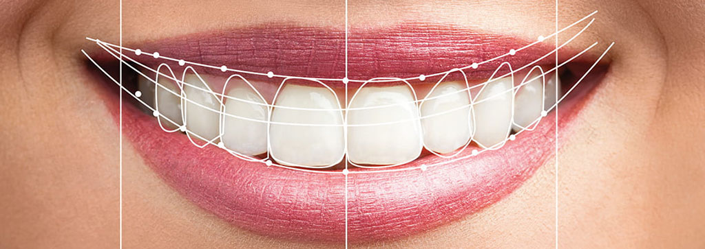 Kayseri’de Gülüş Tasarımı Nasıl Yapılır?